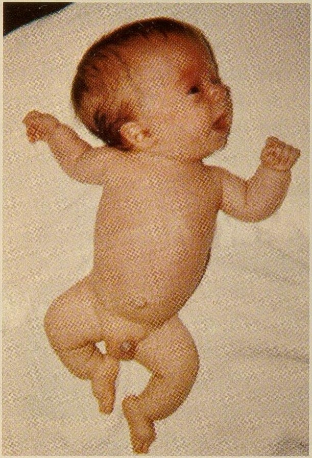 Neue Studie: 21 bisher unbekannte Genvarianten bei Osteogenesis Imperfecta entdeckt