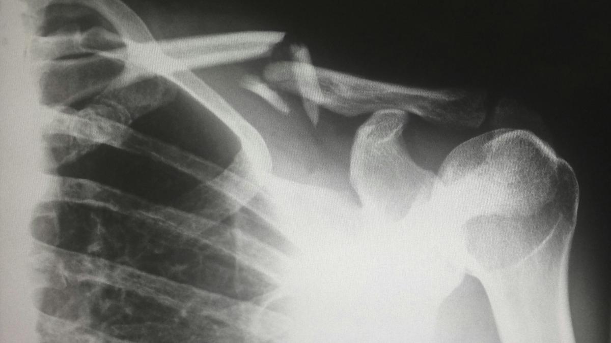 Aktueller Überblick: Was gibt es Neues bei Osteogenesis Imperfecta?